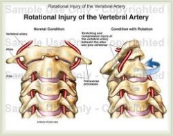pinched vertebral artery symptoms