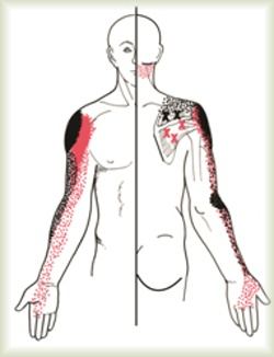 Trigger point myotherapy