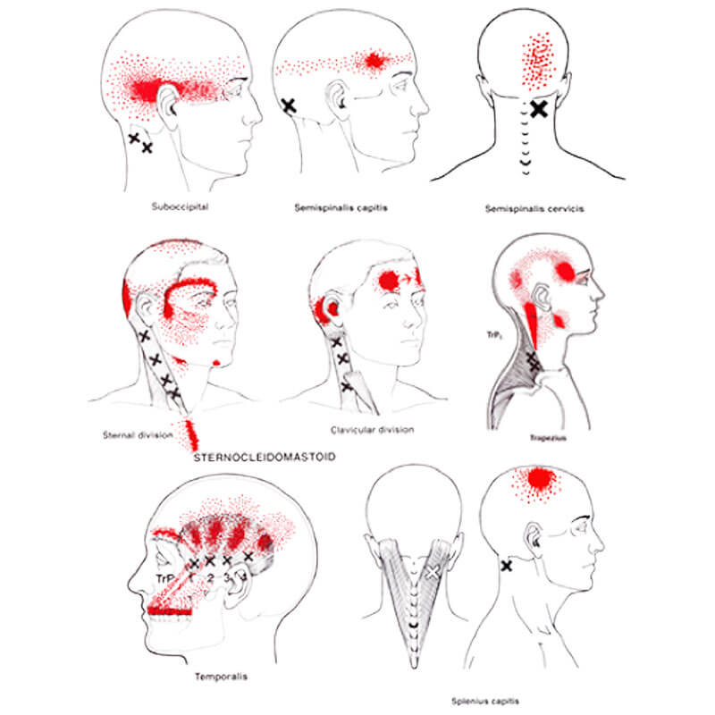 myofascial headache symptoms