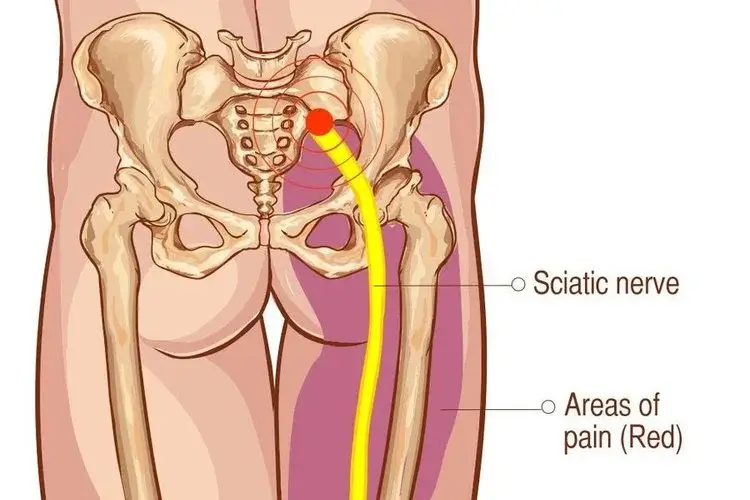 trapped sciatic nerve symptoms in hip