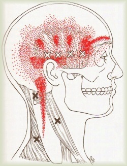 триггерные точки головной боли напряжения